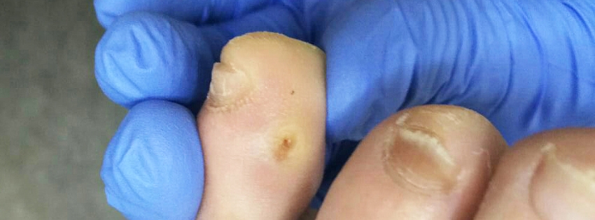 Callos entre los dedos